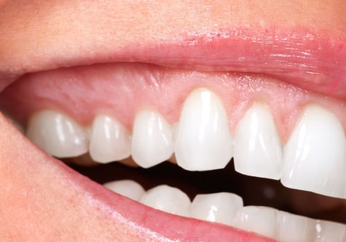 Can the cosmetic dentist make fillings?