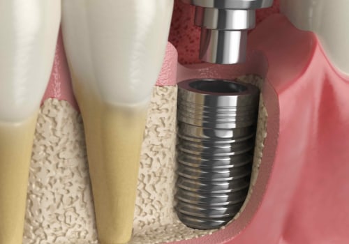 Can a cosmetic dentist make implants?