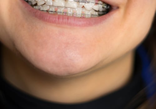 What is cosmetic orthodontics?